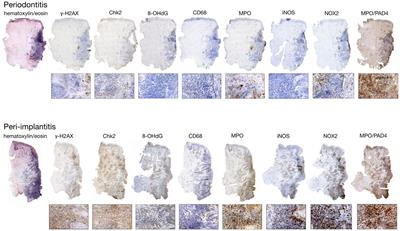 Role of immune dysregulation in peri-implantitis